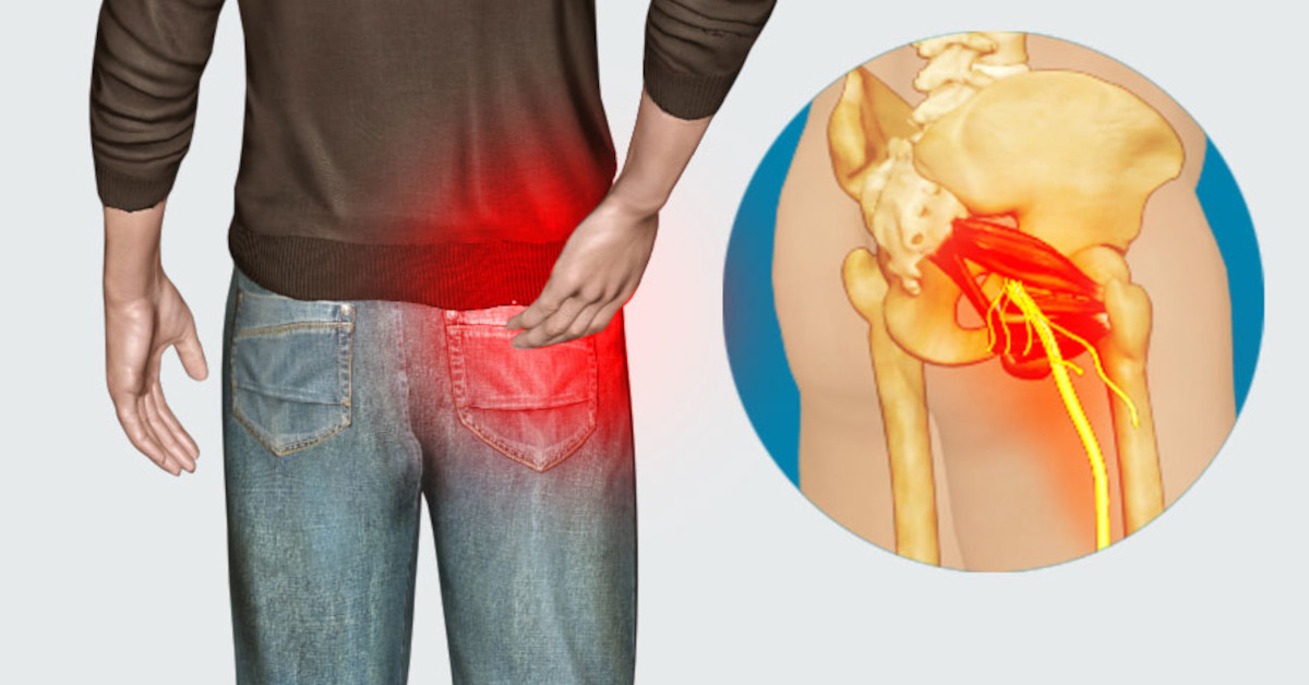 Các triệu chứng của đau dây thần kinh tọa